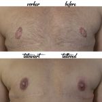miss nico allstyletattoo berlin breast papilla reconstruction nipplesreconstruction male nipple transgender areola
