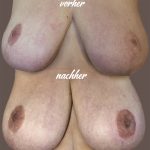 miss nico allstyletattoo berlin breast papilla reconstruction nipplesreconstruction female nipple areola breastcancer surviver brustwarzen rekonstruktion einseitige Brustwarzenrekonstruktion BWK BWKbyAndyEngel AllStyleTattooBerlin